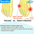 Chiroplax Tailor's Bunion Corrector Pads Bunionette Pain Relief Pinky Little Toe Straightener Separator Cushion Splint Protector Shield Spacer Cov...