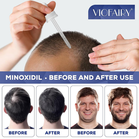 5% Minoxidil for Men, Minoxidil for Women Hair Growth, Minoxidil for Beard Growth, Hair Regrowth for Men, Minoxidil 5 Percent Hair Loss Treatments...