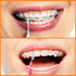 Zopeal 250 Pieces Braces Flossers Interdental Brush for Cleaner Tooth Toothpick Dental Teeth Flossing Head Oral Dental Hygiene Cleaning Tool Soft ...