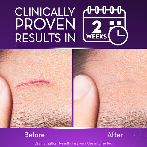 Cicatricure Advanced Scar Gel for Face & Body - Proven Results in 2 Weeks, Scar Treatment for Surgical Scars, Stretch Marks, Scars of Burns and In...