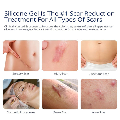 100% Silicone Scar Gel Scar Cream - Advanced Scar Gel for Surgical Scars, C-Section, Stretch Marks, Acne, Injury, Burns, Keloids, Old and New Scar...