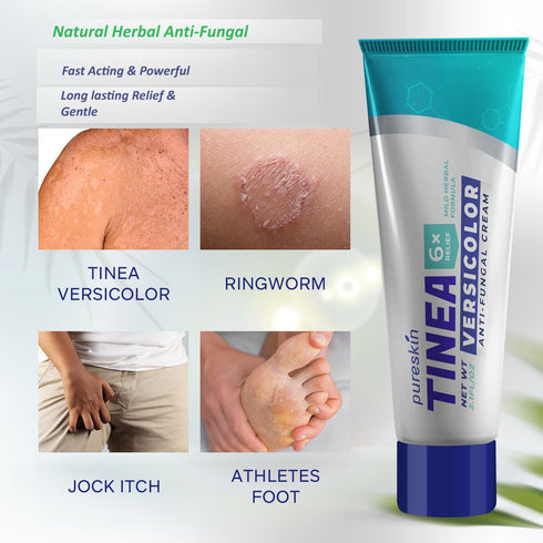 Tinea Versicolor Treatment Antifungal Cream: Extra Strength Natural Anti Fungal Anti Itch - for Tinea Versicolor Ringworm Athlete's Foot Jock Itch...