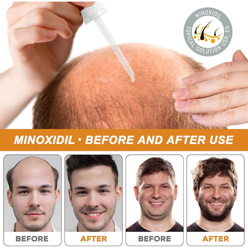 5% Minoxidil for Men Women, Minoxidil for Beard and Hair, Hair Growth Serum Infused Biotin for Thinning Hair and Hair Loss, Topical Solution - 1 M...