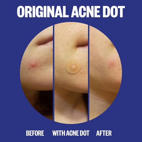Peace Out Skincare Acne Day & Night Duo. 6-hour Fast Acting Sheer Hydrocolloid Pimple Patches and Overnight Acne Dots with Salicylic Acid, Sticker...