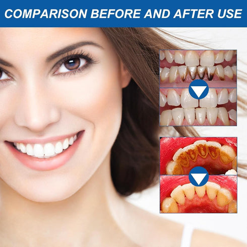 Frosty Neptune Teeth Whitening, Frosty Neptune Teeth Whitening Essence, Fast and Effective Removal Tooth Stain, Reduce Yellowing Teeth Whitening G...