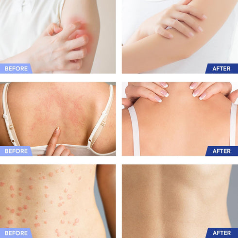 Tinea Versicolor Treatment Antifungal Cream: Extra Strength Natural Anti Fungal Anti Itch - for Tinea Versicolor Ringworm Athlete's Foot Jock Itch...