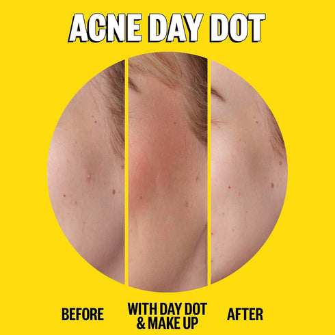 Peace Out Skincare Acne Day & Night Duo. 6-hour Fast Acting Sheer Hydrocolloid Pimple Patches and Overnight Acne Dots with Salicylic Acid, Sticker...