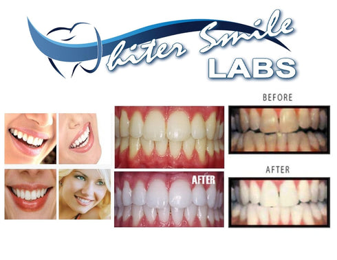 5 XL 38% Teeth Whitening Gel Dentist Recommended High Intensity Carbamide Peroxide Pro Dental Lab Direct, Sensitivity Free, Sold by Dentists, Whit...