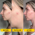 No BS Healing Acne Patches - Hydrocolloid, Acne Spot and Pimple Treatment to Prevent Acne Scars. Invisible On All Skin Tones (1 BOX of 36ct). Incl...