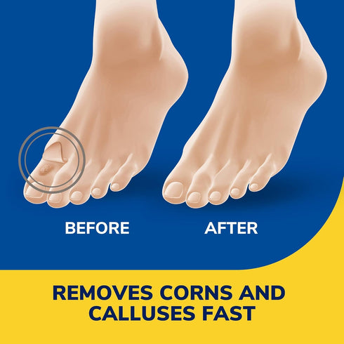 Dr. Scholl's LIQUID CORN & CALLUS REMOVER, 0.33 Ounce // Removes Corns & Calluses Fast with Cushions That Provide Protection Against Shoe Pressure...
