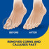 Dr. Scholl's LIQUID CORN & CALLUS REMOVER, 0.33 Ounce // Removes Corns & Calluses Fast with Cushions That Provide Protection Against Shoe Pressure...