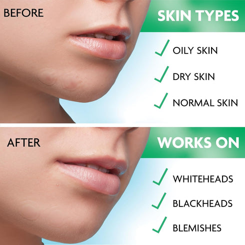 Pimple Patches for Face | Hydrocolloid Acne Patches for Face | Invisible Pimple Patch | Zit Patches for Face | Acne Patch | Zit Stickers | Acne Do...