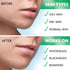 Pimple Patches for Face | Hydrocolloid Acne Patches for Face | Invisible Pimple Patch | Zit Patches for Face | Acne Patch | Zit Stickers | Acne Do...
