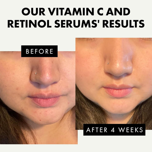 Eclat Skincare Face Serum Set - Vitamin C Serum for Radiance, Retinol Serum for Wrinkles...