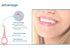 Clear aligner removal tool-invisible removable braces, invisible aligner remover-aligner remover-fixer remover(80PCS)...