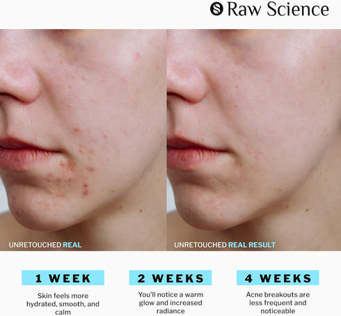 Anti Acne Supplements Cystic Acne Treatment for Teens – Hormonal Acne Pills with Acne Vitamins for Men & Women – clear skin supplement: Vitamin A,...