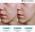 Anti Acne Supplements Cystic Acne Treatment for Teens – Hormonal Acne Pills with Acne Vitamins for Men & Women – clear skin supplement: Vitamin A,...