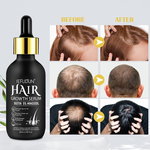 5% Minoxidil Hair Growth Serum,Minoxidil Hair Growth, Hair Loss and Hair Regrowth Oil With Biotin Hair Regrowth Treatment for Scalp Hair Loss Hair...