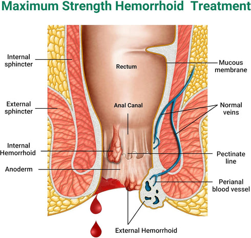 LMNOOP® Hemorrhoid Treatment Ointment, Maximum Strength Treatment & Fast Relief for Pain, Itching, Burning, Swelling, Fissure, Bleeding, Discomfor...