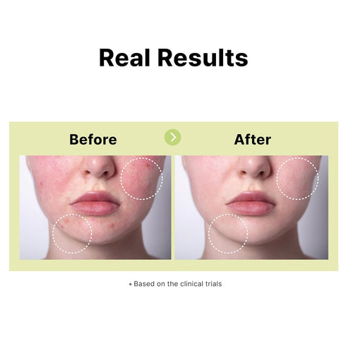 10% Azelaic Acid Serum with Niacinamide, Salicylic Acid, Allantoin, Rosacea Treatment for Face Redness Relief, Reduce Cystic Acne Scar, Pimples, N...