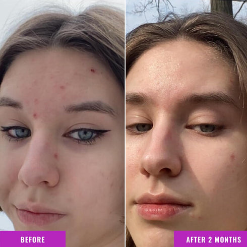 Good Molecules Niacinamide Serum - 10% Niacinamide B3 Facial Serum for Blemishes, Enlarged Pores, Balancing and Hydrating - Skincare for Face...