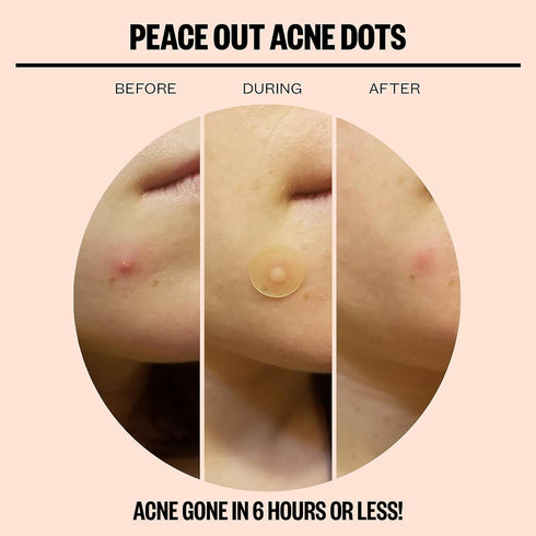 Peace Out Skincare Acne Dots, Hydrocolloid Pimple Patches Help Clear Blemishes Overnight, Fast Acting Anti-Acne Solution (10 dots)...