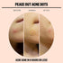 Peace Out Skincare Acne Dots, Hydrocolloid Pimple Patches Help Clear Blemishes Overnight, Fast Acting Anti-Acne Solution (10 dots)...
