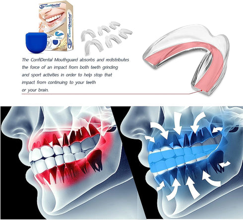 Mouth Guard for Grinding Teeth at Night - 2 Models for Larger Mouth Pack of 6 Moldable Dental Night Guards for Teeth Grinding and Clenching Teeth ...