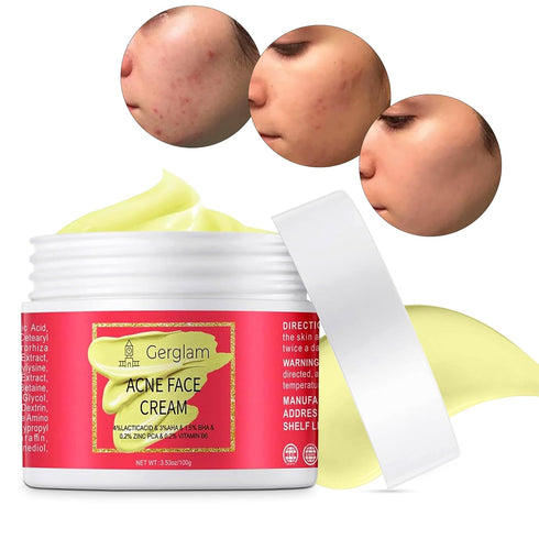 Acne Spot Treatment for Face - Advanced Acne Cream with Salicylic Acid, Pimple and Blemish Spot Treatment, Cystic Acne Treatment & Acne Medication...