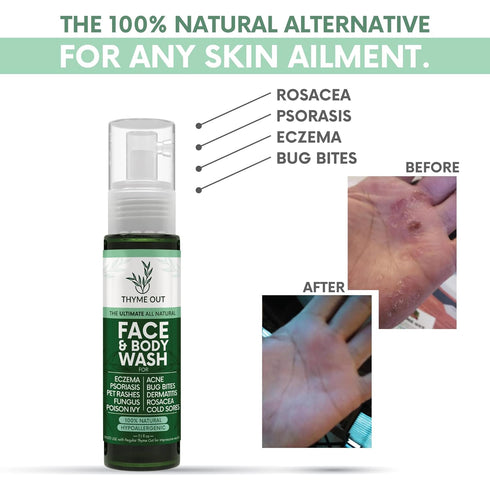 All Natural Face & Body Wash for Eczema, Psoriasis, Pet Rashes, Poison Ivy, Acne, Bug Bites, Dermatitis, Rosacea & Cold Sores - Soothes Itching, a...