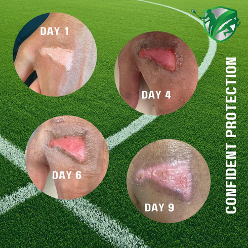 TURFGUARD Turf Burn and Wound Dressing, Hydrogel Pads with X-Static Silver, Soothing, Cooling Protective Treatment for Grass Burns & Wounds, 2" x ...