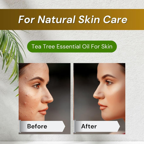 Organic Tea Tree Oil - 100% Pure Tea Tree Oil for Skin, Hair, Toenails, Scalp, Acne - Tea Tree Essential Oil for Aromatherapy - 1 oz/30ml...