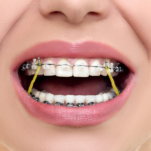 JMU Orthodontic Elastics 1/4 Medium, 300 Pack Latex Orthodontic Rubber Bands, Intraoral Elastic Bands Dental Rubber Bands Made in USA...