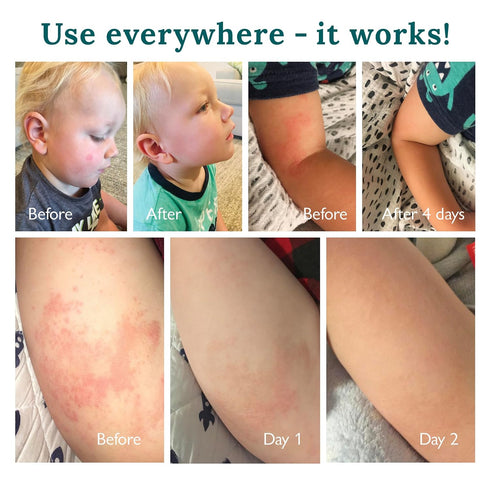 Baby and Kids Moisturizing Cream for Sensitive Skin Multi Purpose for Eczema Psoriasis Rosacea Dermatitis Rash, Healing Therapy for Dry Cracked Ir...