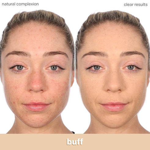Almay Clear Complexion Acne Foundation Makeup with Salicylic Acid - Lightweight, Medium Coverage, Hypoallergenic, -Fragrance Free, for Sensitive S...