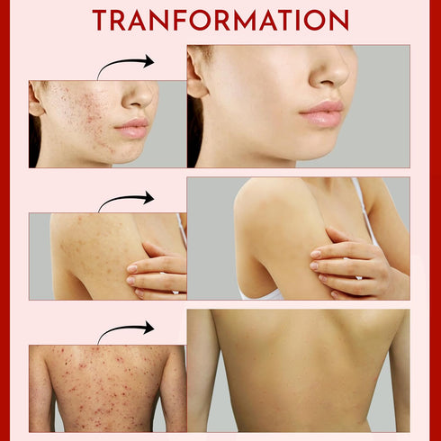 Acne Spot Treatment for Face - Advanced Acne Cream with Salicylic Acid, Pimple and Blemish Spot Treatment, Cystic Acne Treatment & Acne Medication...