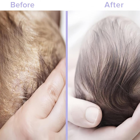 Cradle Cap Treatment Shampoo - Organic Honey Mousse - Tear-Free - Suitable for Babies Toddlers with Dry, Sensitive Eczema-Prone Scalp - 6.76 fl.oz...