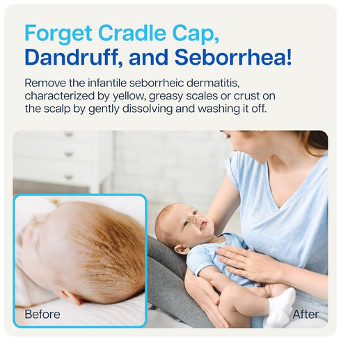 NAVEH PHARMA Cradle Cap Cleanser For Baby & Kids | 100% Natural Cradle Cap Treatment | Spray & Wash No Scrubbing | Better Than Shampoo Or Brush | ...