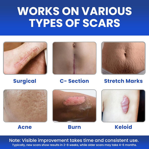 AWD Silicone Scar Sheets for Scar Removal - Extra Thick 0.5mm Silicone Scar Tape for Surgical Scars, C Section, Keloid - Silicone Skin Patches Ext...
