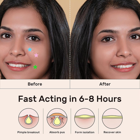 Star Pimple Patches - Hydrocolloid Acne Pimple Patches for Covering Zits and Blemishes, Cute Spot Stickers Skincare Acne Absorbing Cover Patch for...