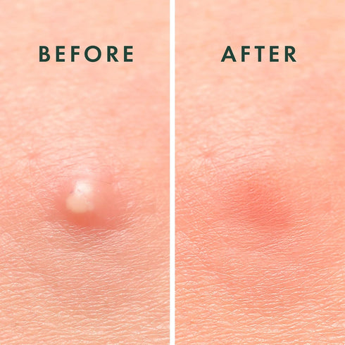 Rael Pimple Patches Miracle Invisible Spot Cover - Hydrocolloid Acne for Face, Blemishes and Zits Absorbing Patch, Breakouts Treatment Skin Care, ...
