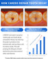 Upgraded Taste - Home Cavity Repair Toothpaste Hydroxyapatite Toothpaste Reverse Cavities Dental Caries, Remineralizing Tooth Decay Treatment for ...