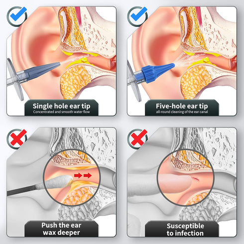 Ear Wax Removal, Ear Cleaner, Ear Wax Removal Kit, Manual Ear Irrigation Flushing System, Ear Cleaning Kit, Safe and Effective to Clean Ear Built ...