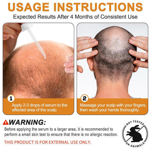 5% Minoxidil for Men Women, Minoxidil for Beard and Hair, Hair Growth Serum Infused Biotin for Thinning Hair and Hair Loss, Topical Solution - 1 M...