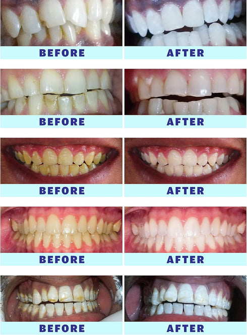 Kit, 10 Mins Express Results Teeth Whitening 35% CP Gel with Rechargeable LED Light, USA Dentists Recommended...