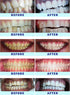 Kit, 10 Mins Express Results Teeth Whitening 35% CP Gel with Rechargeable LED Light, USA Dentists Recommended...