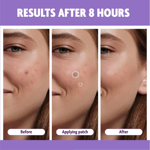 Magnesium Acne Patch: Innovative Treatment for Acne, Dark Spots, Blemishes, and Cystic Acne - Patented & Clinically Tested Spot Solution (MEDIUM 8...