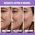 Magnesium Acne Patch: Innovative Treatment for Acne, Dark Spots, Blemishes, and Cystic Acne - Patented & Clinically Tested Spot Solution (MEDIUM 8...