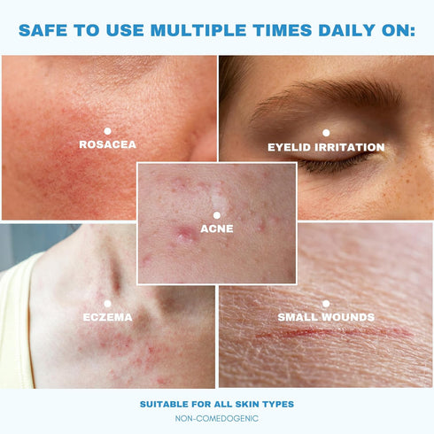 0.015% Hypochlorous Acid Spray - HOCL - Antibacterial Hypoallergenic Sensitive Skin Toner Cleanse, Soothe for Face and Body - Acne - Eczema - Post...