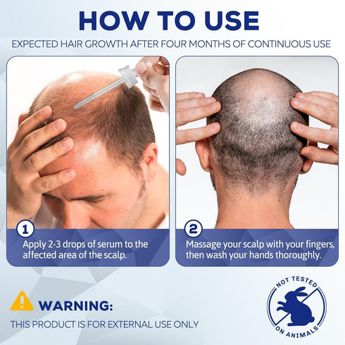 5% Minoxidil for Men, Minoxidil for Women Hair Growth, Minoxidil for Beard Growth, Hair Regrowth for Men, Minoxidil 5 Percent Hair Loss Treatments...